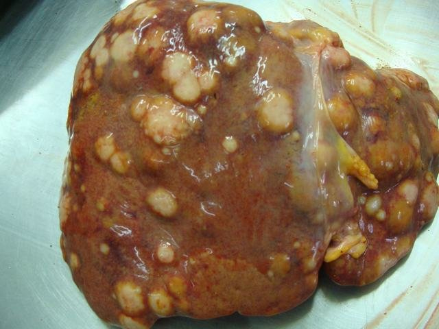 secondaries liver